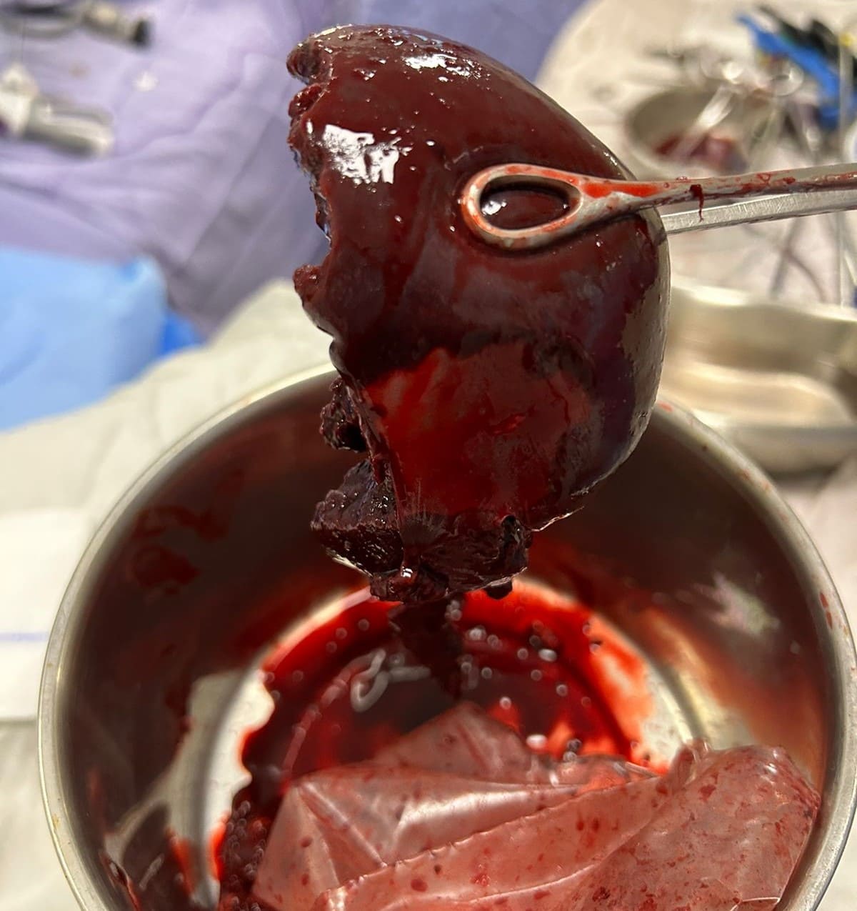 Esplenectomía
