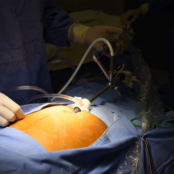 Colecistectomía endoscópica de mínima invasión.
“Cirugía Sin Huella”