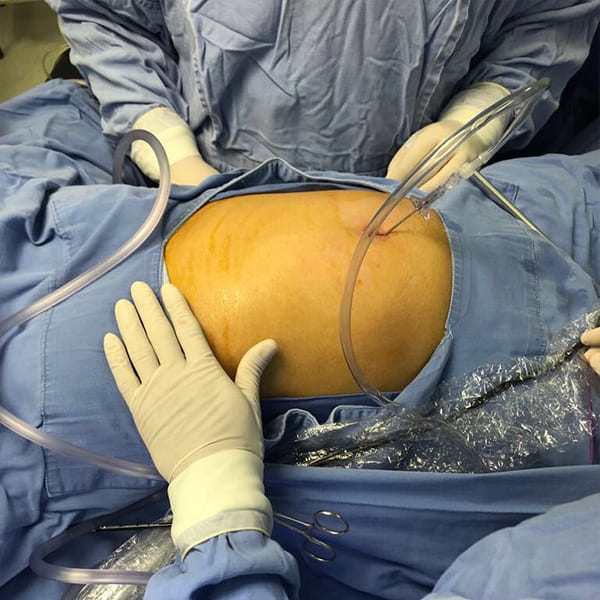 Colecistectomía endoscópica de mínima invasión.
“Cirugía Sin Huella”